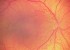 retinopatie-nedonosenych.jpg - kopie